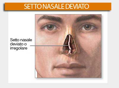 Setto nasale deviato - Rinosettoplastica